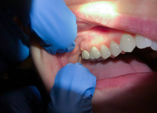 Best Broken or Chipped Tooth Repair in Winter Gardens, CA